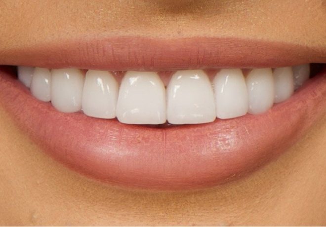 How Veneers Can Change Your Smile and Confidence in London