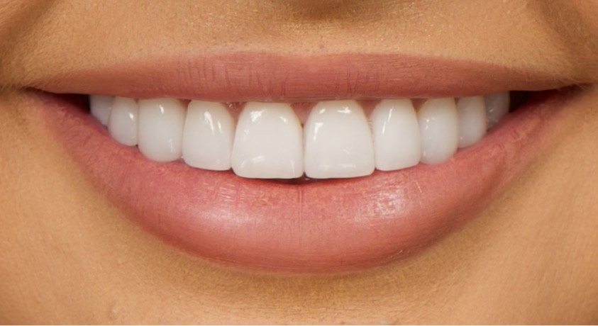 How Veneers Can Change Your Smile and Confidence in London