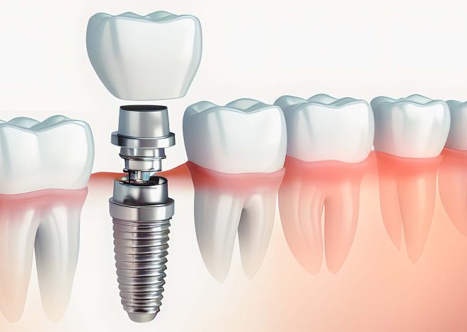 The Benefits of Opting for Dental Implants in Plymouth