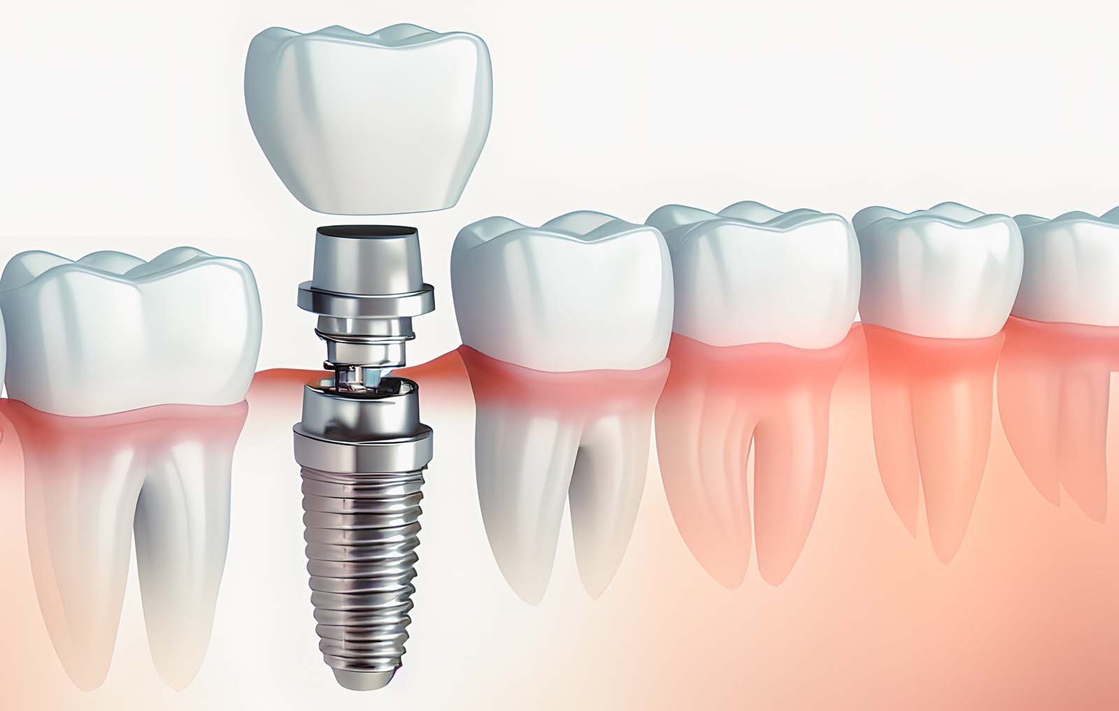 The Benefits of Opting for Dental Implants in Plymouth